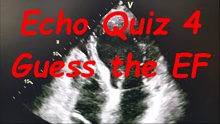 Ejection fraction Quiz 4 Can you guess the EF correctly  Cardiology Forum [upl. by Octave346]