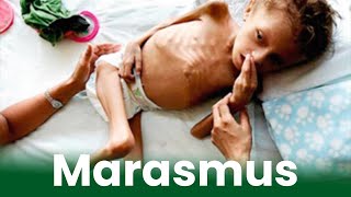 मरास्मस रोग किसकी कमी के कारण होता है Marasmus Disease Symptoms Causes amp Prevention amp Treatment [upl. by Aehtela]