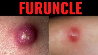 What is Furuncle Furuncle Boil DefinitionCauses Symptoms Risk Factors USMLE [upl. by Elyac]