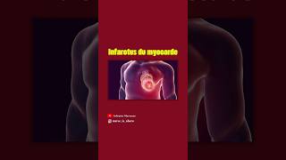 Infarctus du myocarde [upl. by Helbonna]