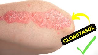 The Ultimate Guide to Clobetasol How to Effectively Treat Skin Conditions [upl. by Aneerhs41]