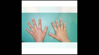 Brachydactyly Treatment  Symptoms and Causes  Diagnosis  Prevention health [upl. by Haelahk]