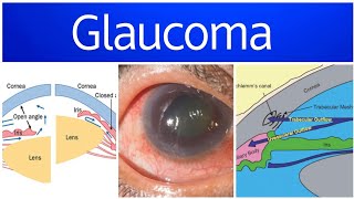 Glaucoma 1  Anatomy PhysiologyDefinition Classification amp Theories [upl. by Anua167]