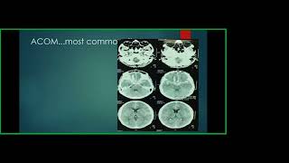 Stroke Case based scenario Dr Md Yousuf Ali [upl. by Rajiv615]