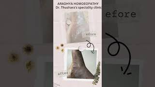 skincare skindisease skinissues skinandhomoeopathy tips healthtalks eczema pyoderma [upl. by Enoj]