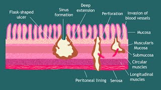 Pathogenesis of Entamoeba histolytica Notes  Parasitology  Basic Science Series [upl. by Brittan785]