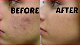 How To Remove Dark Spots Acne Scars Black Spots In Just 3 Days  Get Flawless Glowing Skin [upl. by Hutchins]