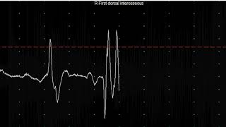 EMG teaching video 20 Myotonia [upl. by Anire]