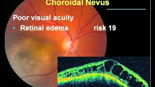 Long Term Followup of a Choroidal Nevi [upl. by Volny]