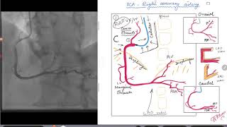 Coronary Angiogram LAO view for RCA Right coronary artery [upl. by Nahtiek]