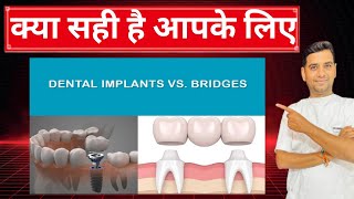 CONFUSIONDENTAL IMPLANT OR DENTAL BRIDGE।।kya sahi hai DENTAL IMPLANT KI DENTAL BRIDGE dentalgyan [upl. by Llevad]