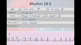 Basic Electrophysiology part 7  Atrial Rhyhtms part 2 WAP MAT EAT SVT [upl. by Grinnell]