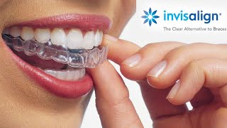 Watch this video before starting INVISALIGN  Starter Kit  Price  Dental Treatment [upl. by Derwon]