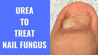 Use Urea To Treat Nail Fungus [upl. by Denman]