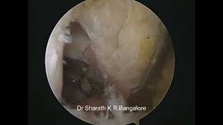 ALL INSIDE PCL RECONSTRUCTION USING PERONEUS LONGUS AUTOGRAFT [upl. by Yriek754]