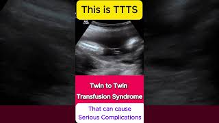 TTTS  Twin to Twin Transfusion Syndrome Ultrasound  Monochorionic TWINS [upl. by Jaynell]