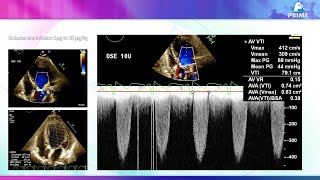 Low Flow Aortic Stenosis Simple and clear [upl. by Adalia547]