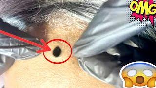 blackheads extractions  blackheads extractions [upl. by Blunt]