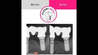 How to treat periodontitis amp periimplantitis nonsurgically with CLEANampSEAL [upl. by Eitsim]