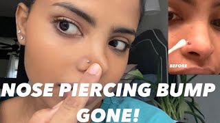 How to Get Rid of a Nose Piercing Bump FAST [upl. by Anahsohs]