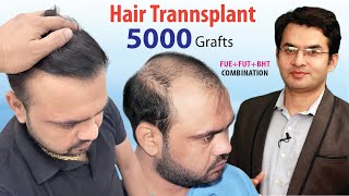 5000 Grafts Hair Transplant Results in Grade 6 by Dr Suneet Soni at Medispa Hair Transplant [upl. by Borek]