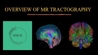 MR TRACTOGRAPHY DIFFUSION TENSOR IMAGING DTI  WHITE MATTER TRACTS ON MRI [upl. by Tniassuot]