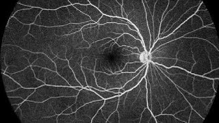 Fundus fluorescein angiography FFA [upl. by Ocnarfnaig787]