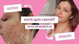 Curei a acne depois de 20 anos 😱 mas o Roacutan falhou [upl. by Halyak621]