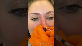 NonSurgical RhinoplastyNose Job LA  Westside Aesthetics  Alexander Rivkin MD [upl. by Eladnek32]