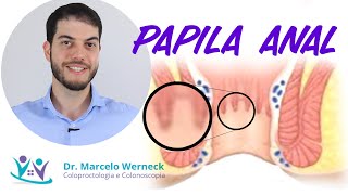 Papila anal hipertrófica O que é Como tratar [upl. by Adikam]