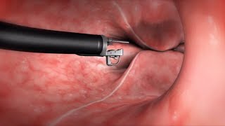 What Happens During the Endoscopic Sleeve Gastroplasty ESG Procedure [upl. by Ryon]