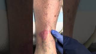 Venous Eczema a Common Cause of Red Itchy Skin on the Lower Leg [upl. by Sesom297]