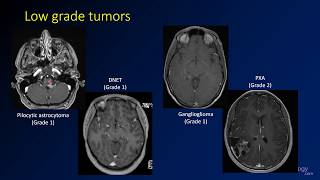 Imaging brain tumors  4  Other low grade gliomas [upl. by Nicolea433]