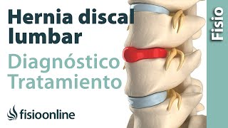 Hernia discal lumbar  Diagnóstico consejos ejercicios y tratamiento de fisioterapia [upl. by Kutchins]