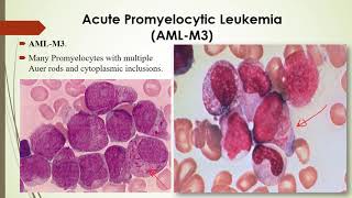 Practical Hematology 12 Morphology of Acute amp chronic leukemia [upl. by Adolpho426]