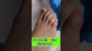 ALARMA 😮pies hinchados cuidado con tus RIÑONES [upl. by Leann]