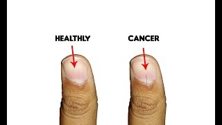 9 Fingernails serious alarming health issues and probllems [upl. by Adni]