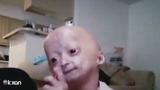 Adalia Rose Austinite social media star with rare genetic condition dies at 15 [upl. by Annahsar544]