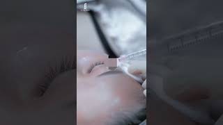 Cleo’s Dark Eye Circle Treatment Experience at RJ CLINIC  Brighter Refreshed Eyes [upl. by Namrac34]