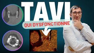 Une valve TAVI qui dysfonctionne après 2 ans  thrombose ou endocardite [upl. by Ainnat]