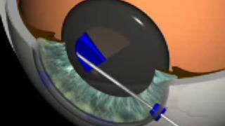 Cataract Surgery 3D Animation O Findl MD Vienna [upl. by Bina]