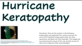 Hurricane Keratopathy [upl. by Zzahc]