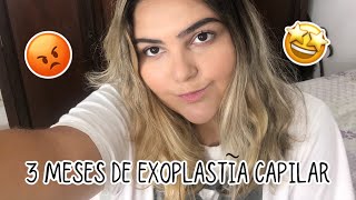 MINHA EXPERIÊNCIA COM A EXOPLASTIA  3 meses [upl. by Aseefan]