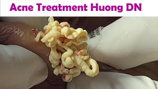 Acne Treatment Huong Da Nang  2024 Acne Huong 715 [upl. by Relyhcs]