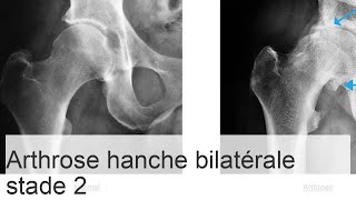 Coxarthrose bilatérale de stade 2  causes symptômes de la maladie méthodes de thérapie [upl. by Alistair980]