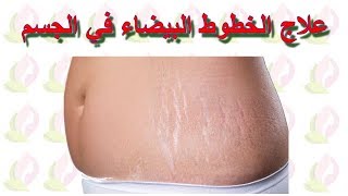 علاج الخطوط البيضاء في الجسم  علامات التمدد  Stretch marks  striae [upl. by Itsud]