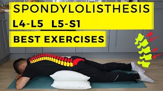 Spondylolisthesis treatment [upl. by Werda]