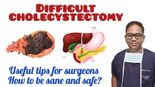 Cholecystectomy being safe and sanetips for surgeonsbest Laparoscopic surgery [upl. by Theresita]