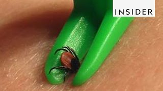 How To Remove Ticks [upl. by Seroled]