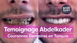 Témoignage Couronnes Dentaires Turquie Abdelkader [upl. by Wiener]